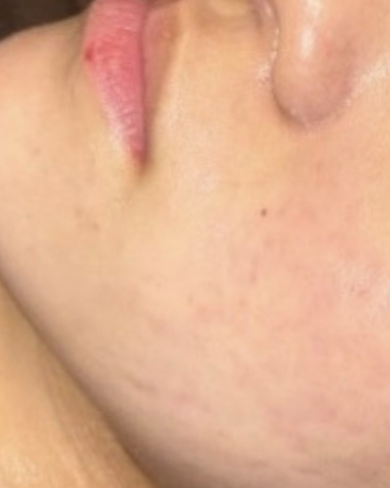 After treatment