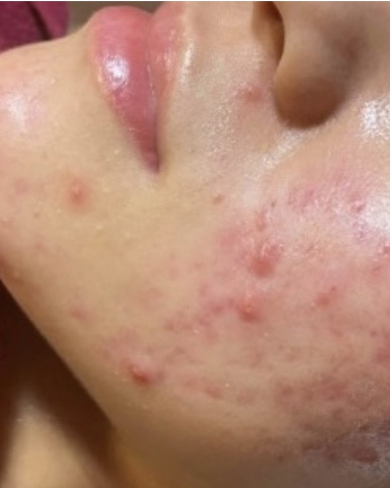 Before treatment