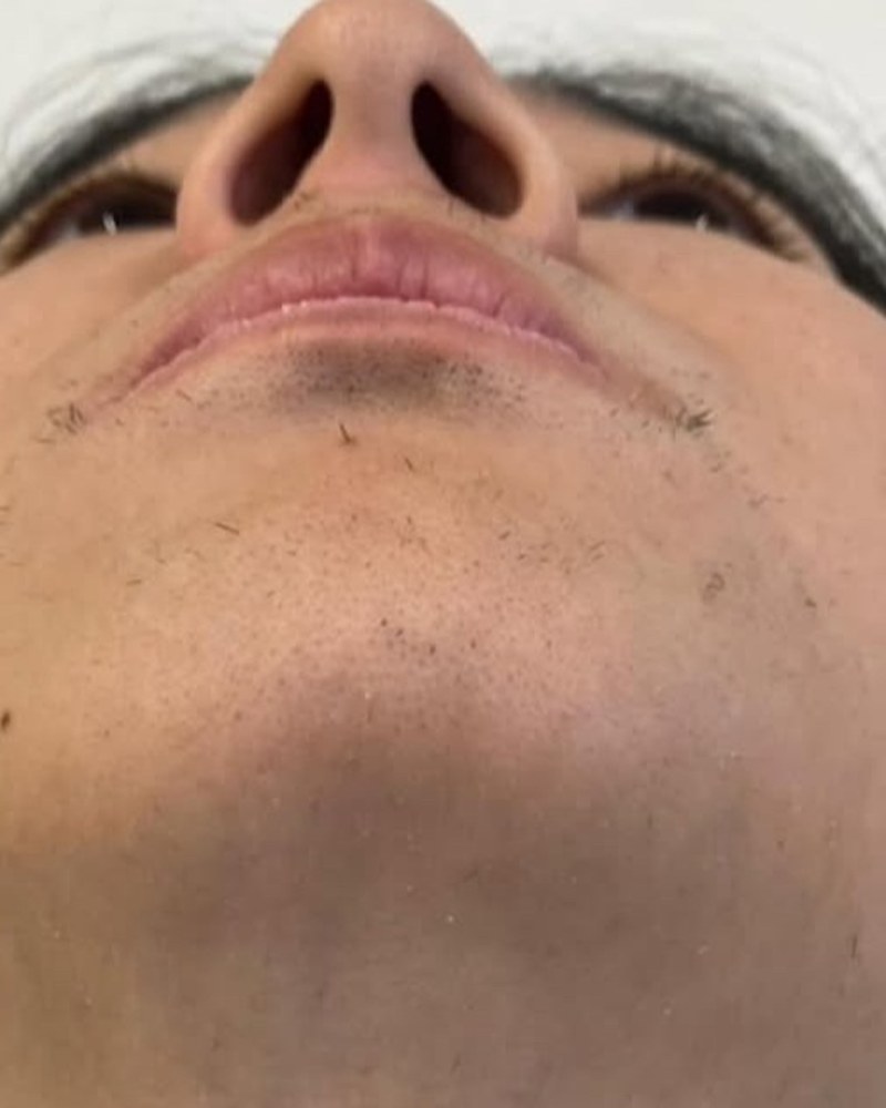 After treatment