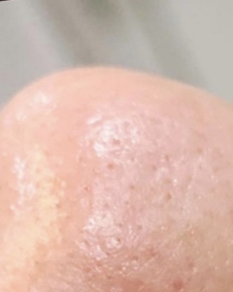 After treatment