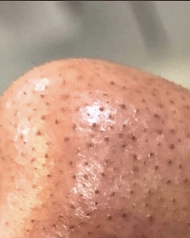 Before treatment