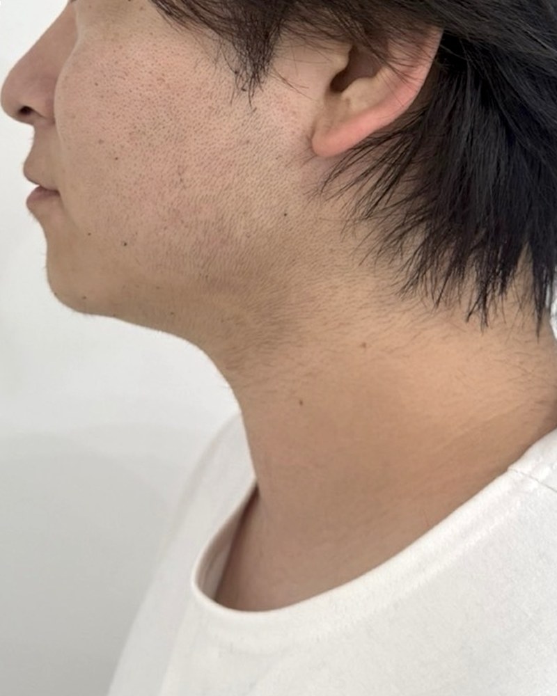 After treatment