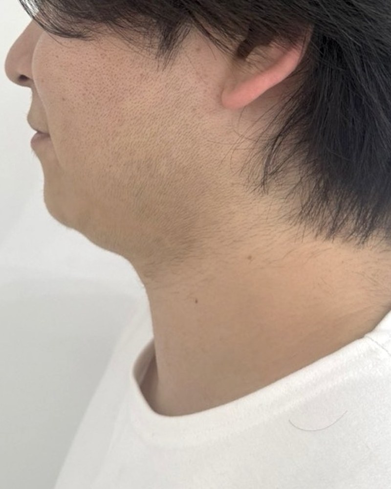 Before treatment