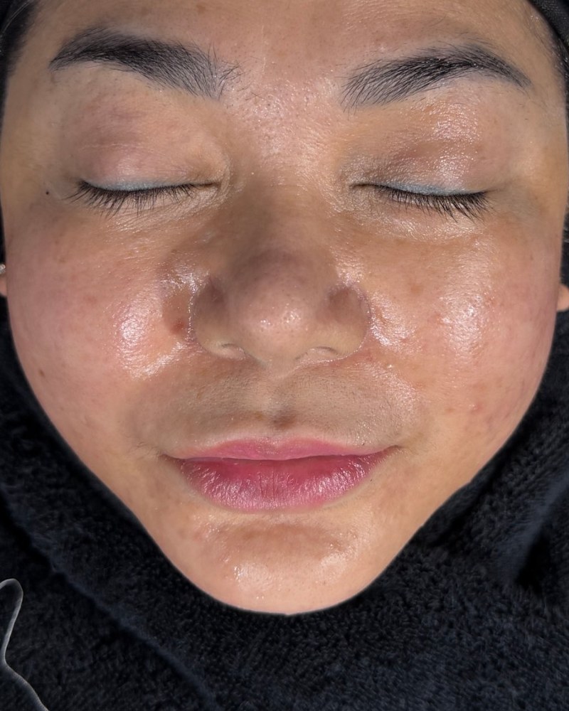 After treatment