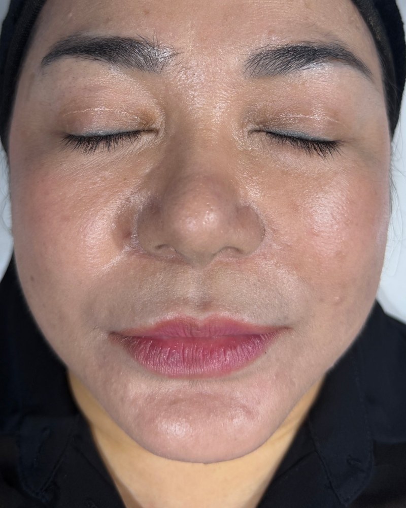 Before treatment