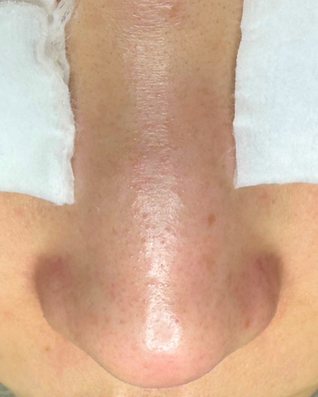 After treatment