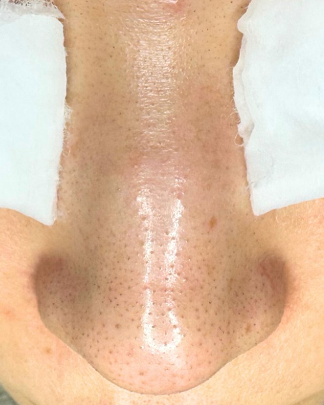 Before treatment