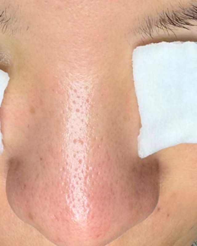 After treatment