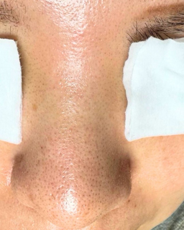 Before treatment