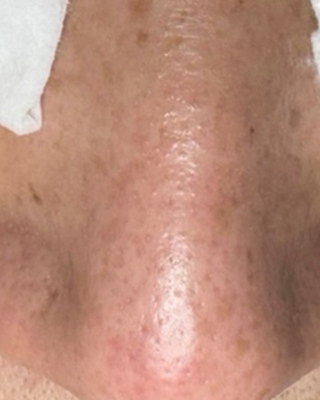 After treatment