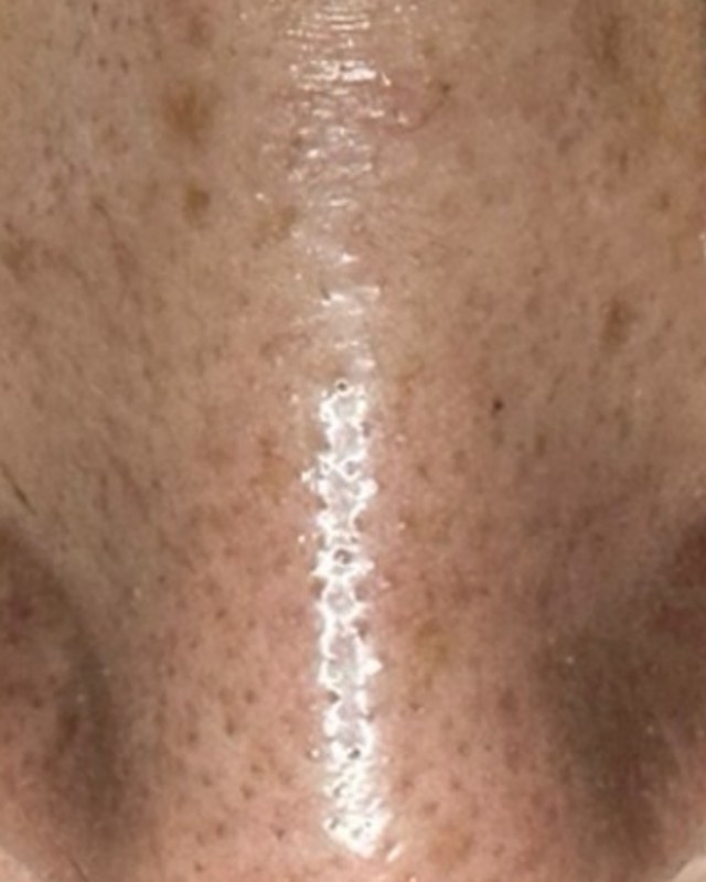 Before treatment