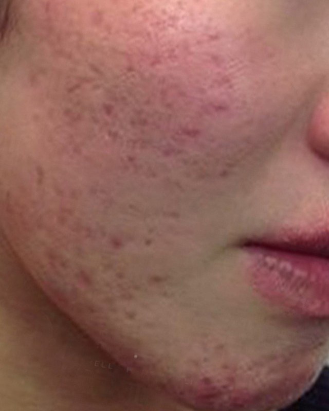 After treatment