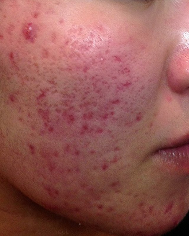 Before treatment