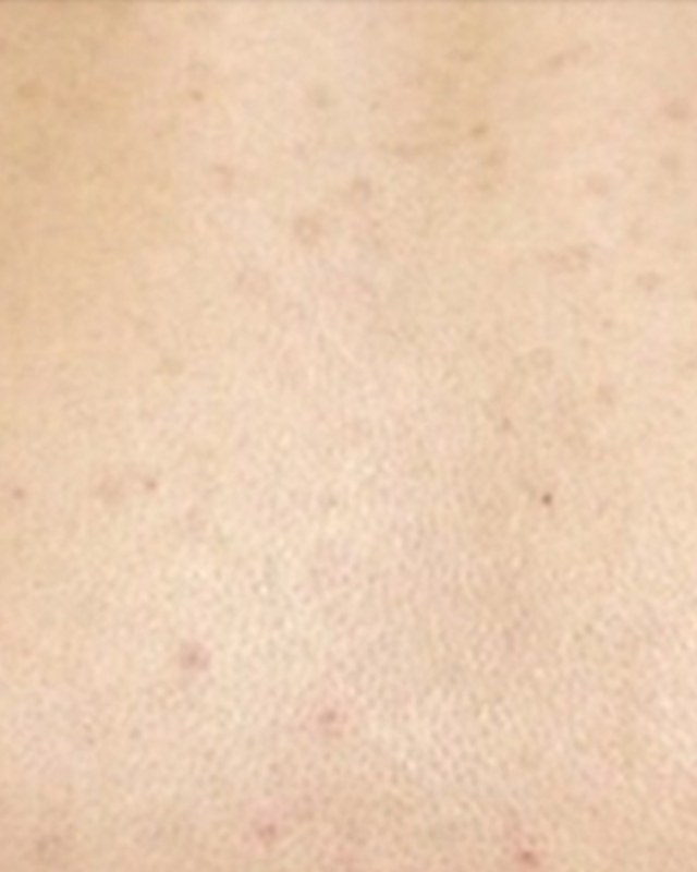 After treatment