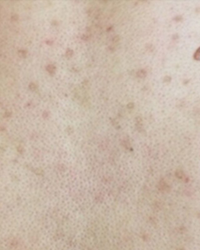 Before treatment
