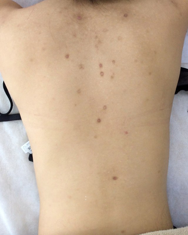 After treatment