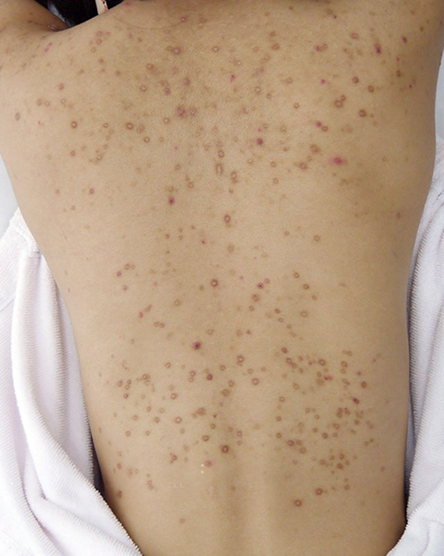 Before treatment
