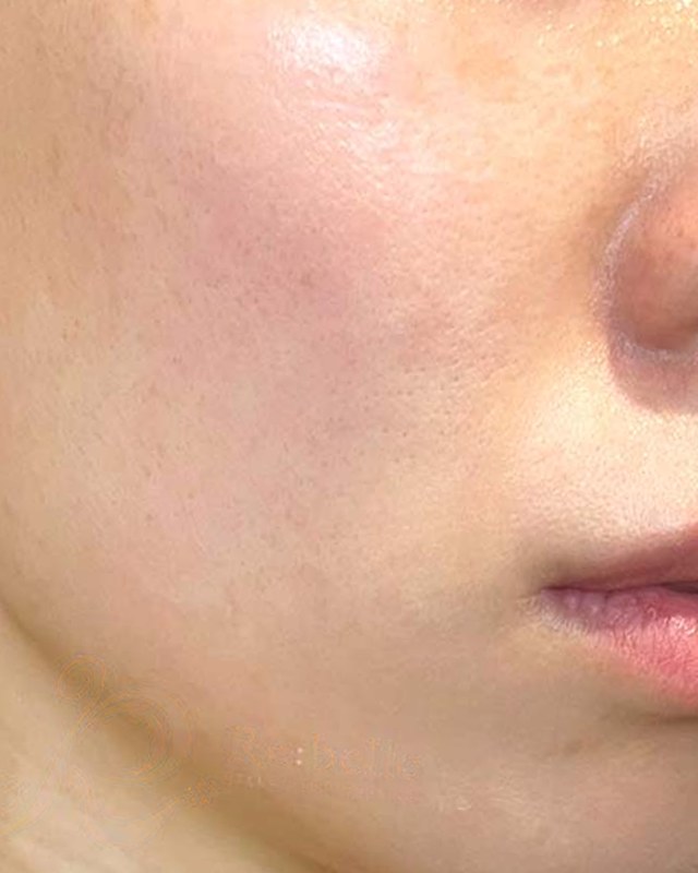 After treatment
