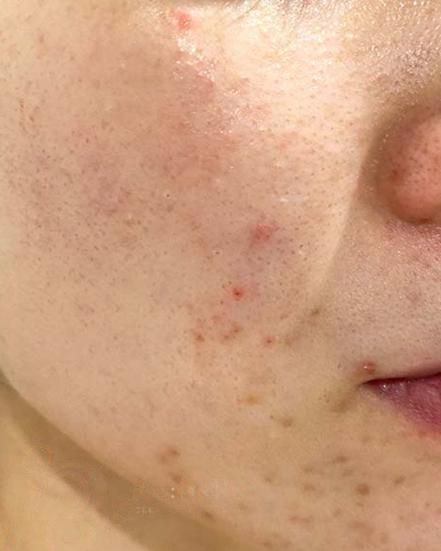 Before treatment