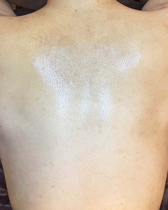 After treatment