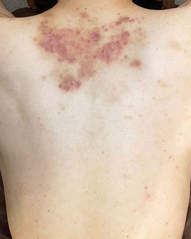 Before treatment