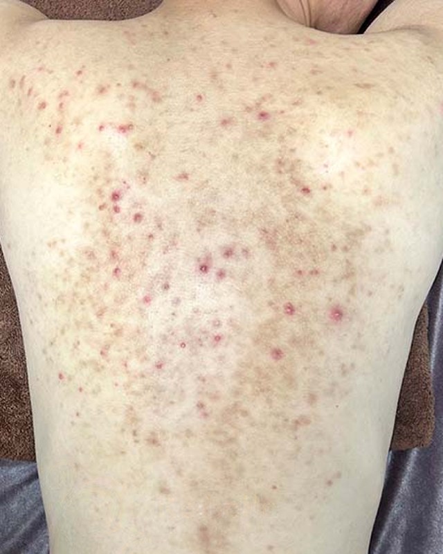 Before treatment