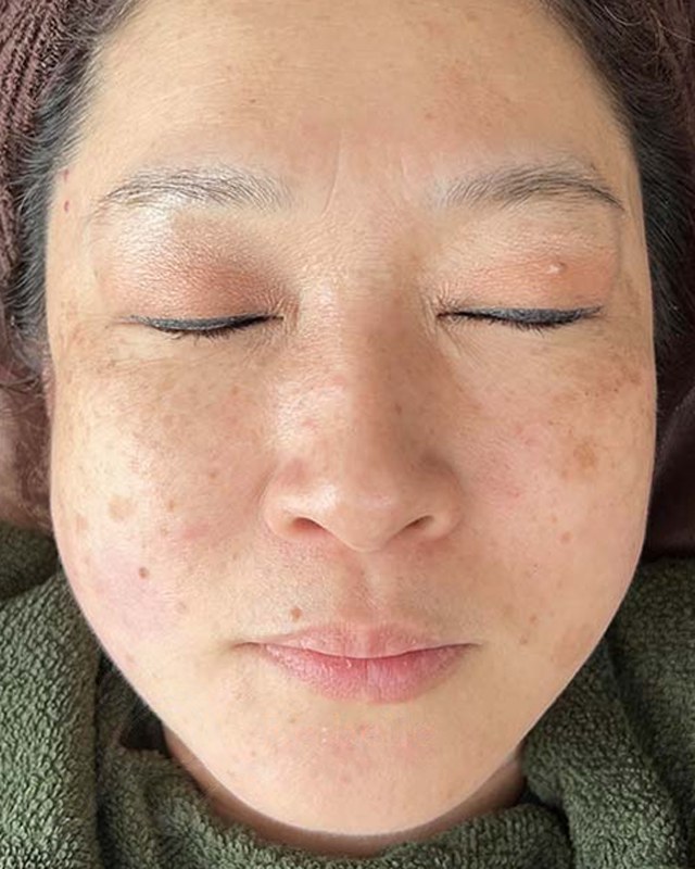 After treatment
