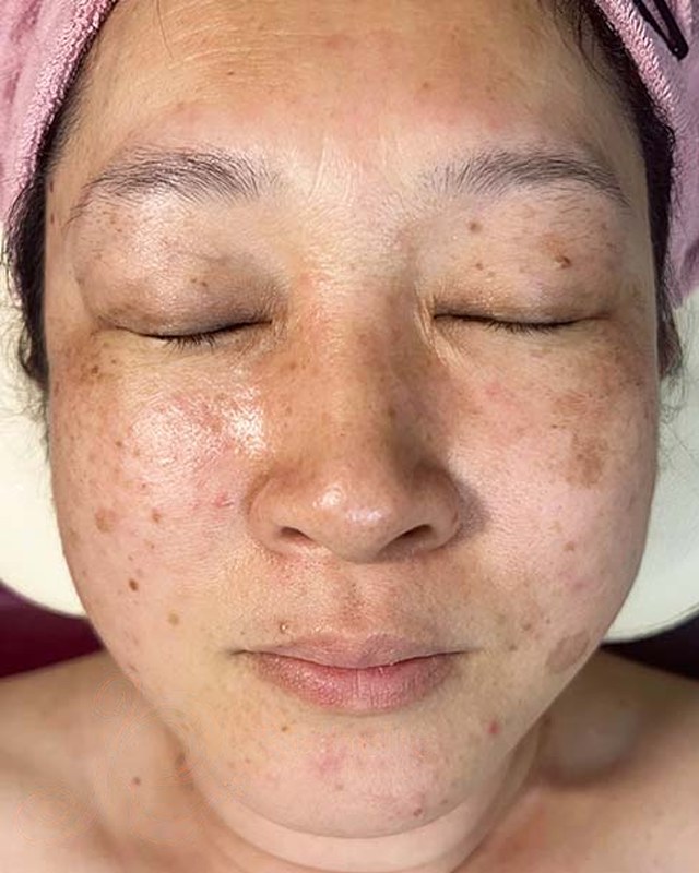 Before treatment