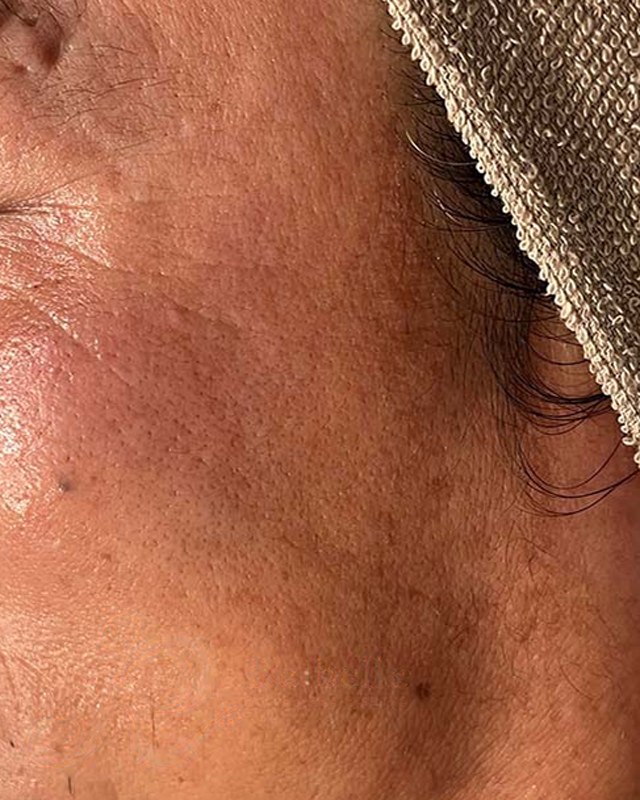 After treatment