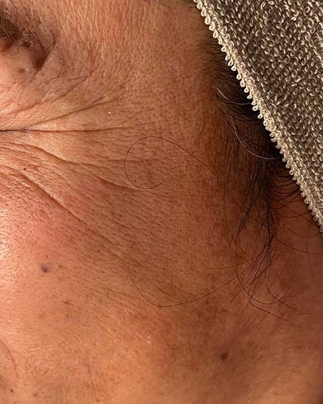 Before treatment