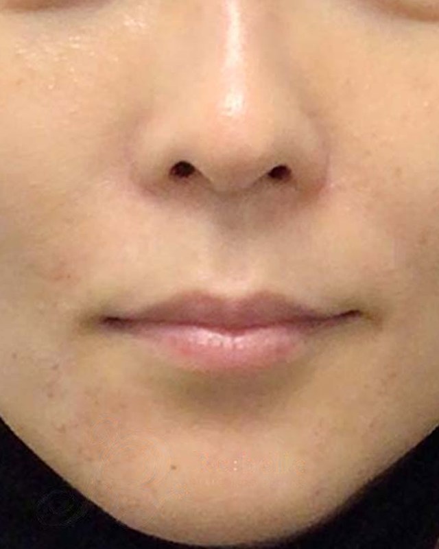 After treatment