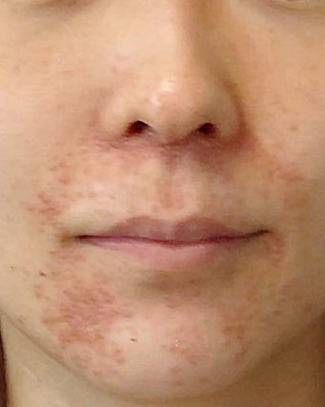 Before treatment