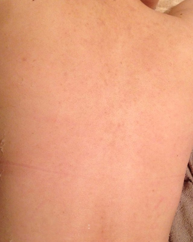 After treatment