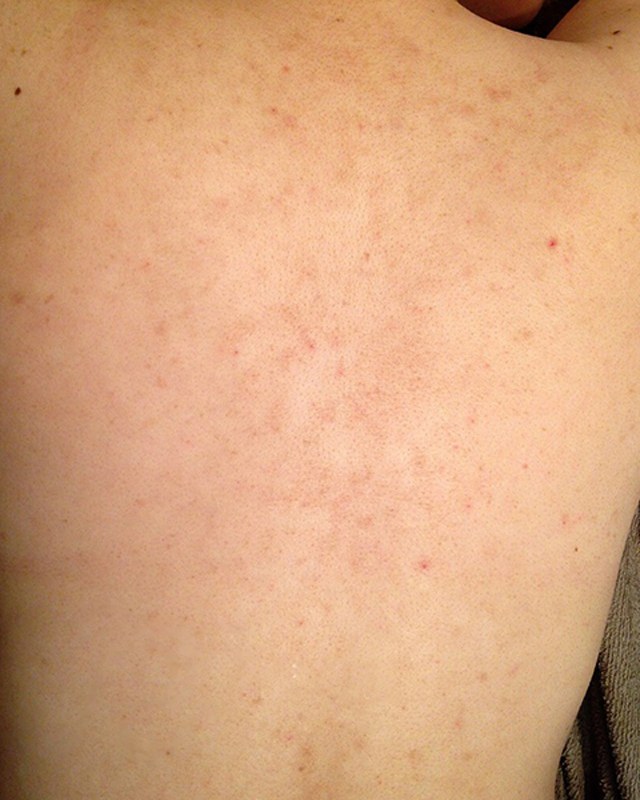 Before treatment