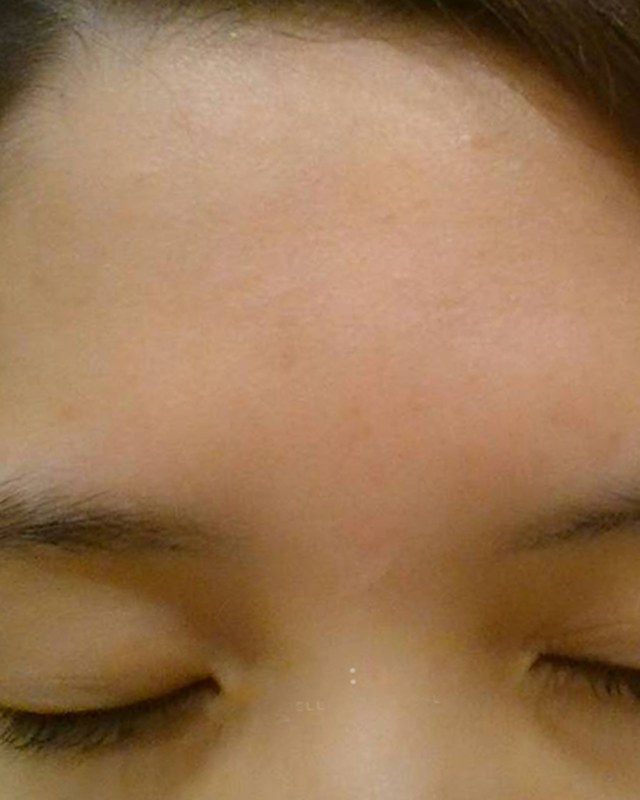 After treatment