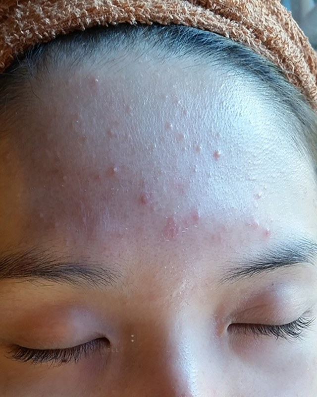 Before treatment