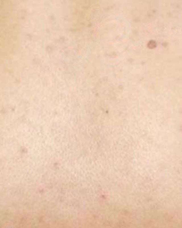 After treatment