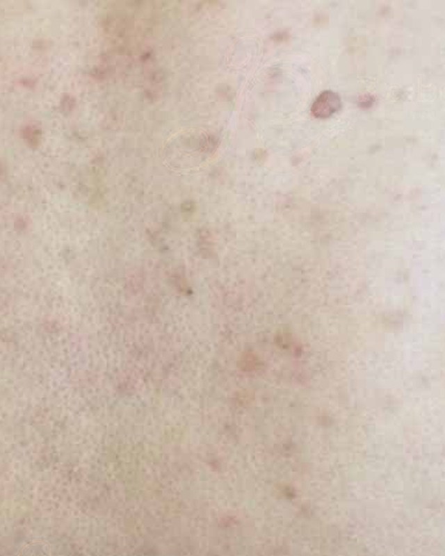 Before treatment