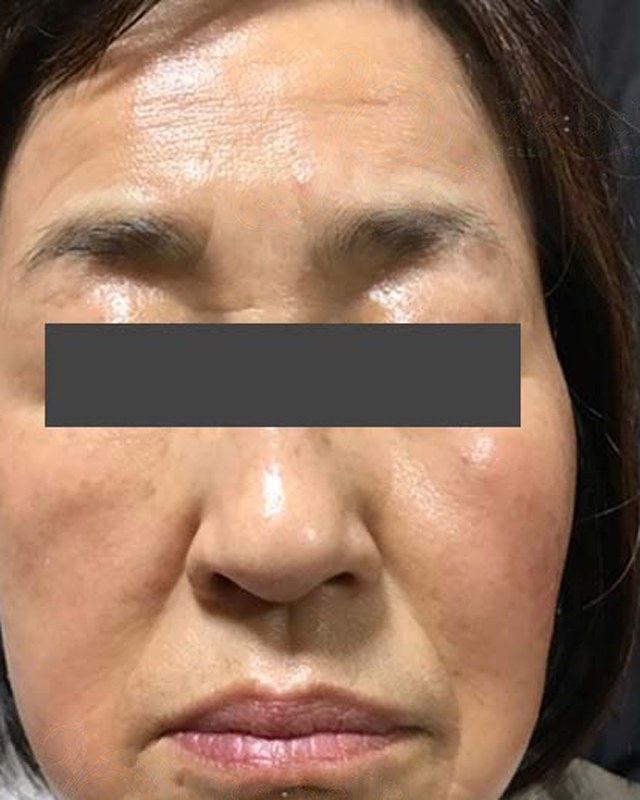 After treatment