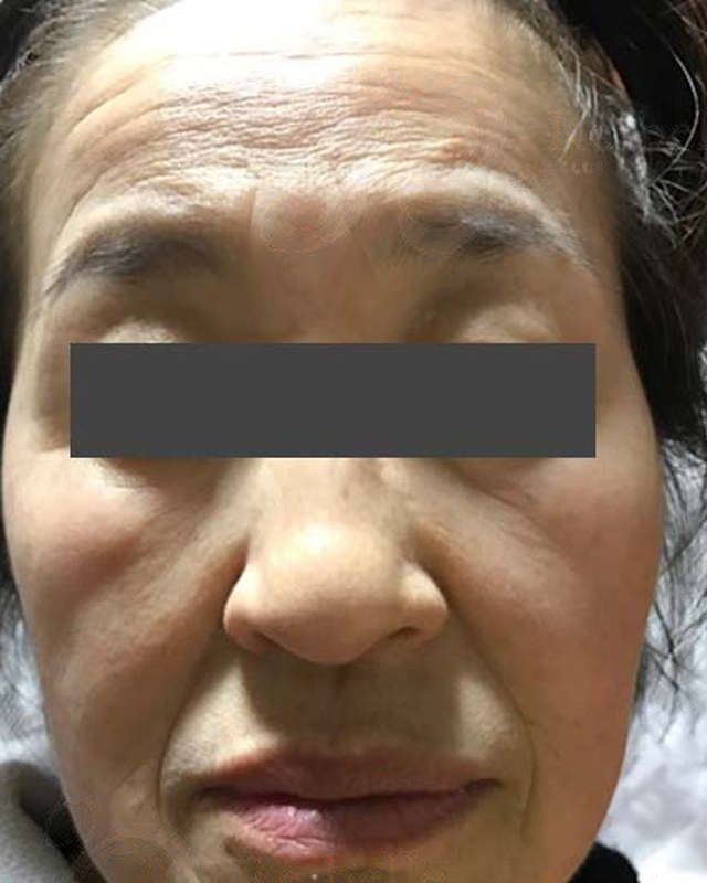 Before treatment