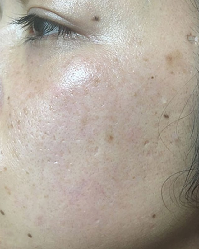 After treatment