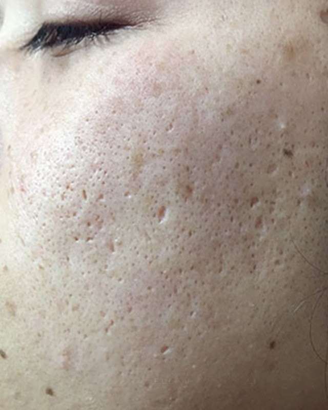 Before treatment