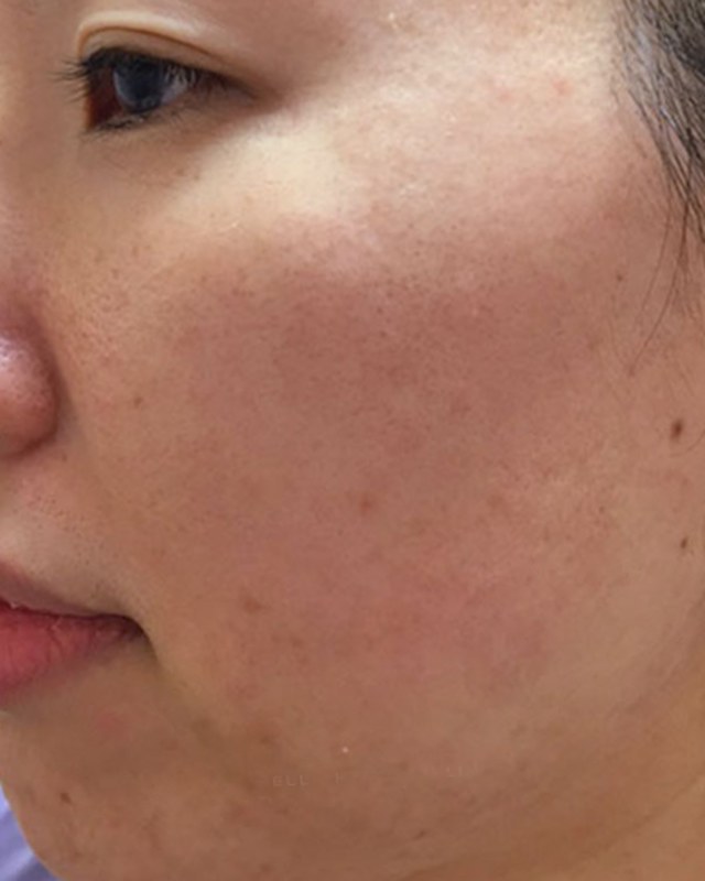 After treatment