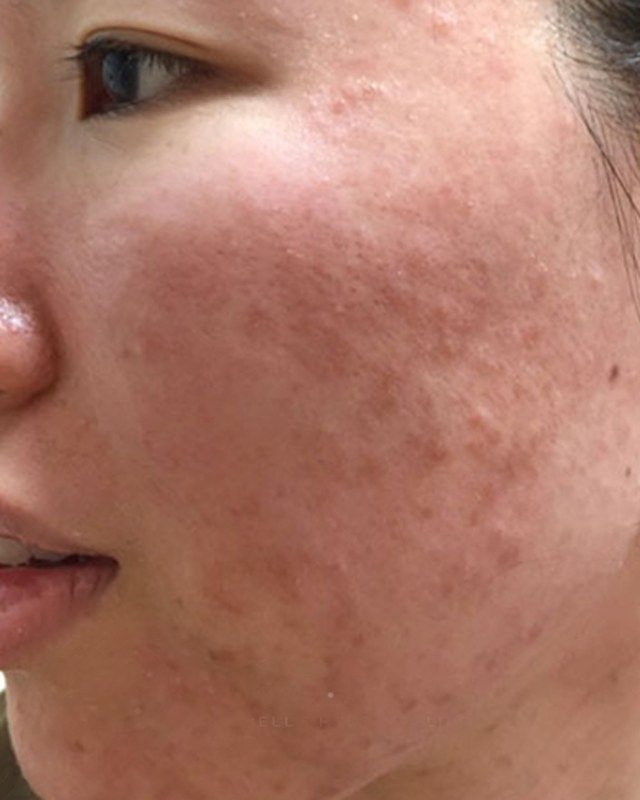 Before treatment