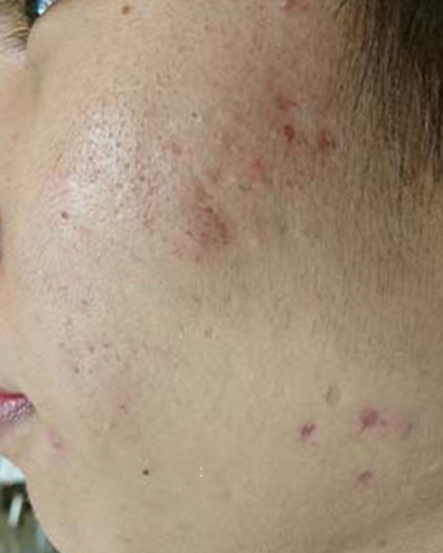 After treatment
