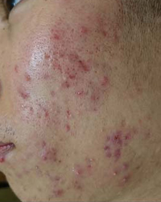 Before treatment