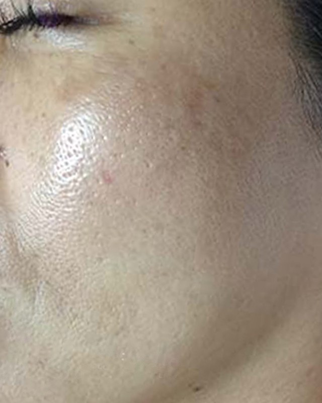 After treatment