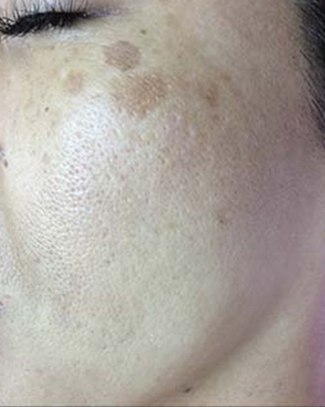 Before treatment