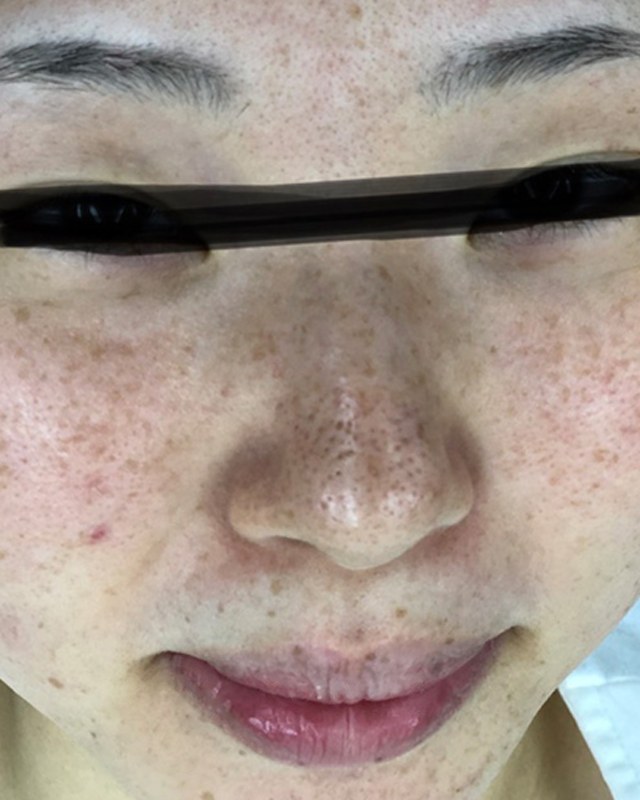 After treatment