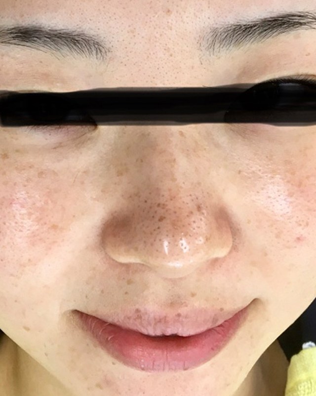 Before treatment